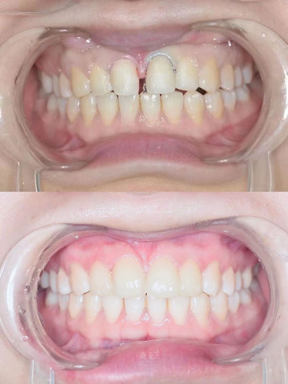 门牙缺了怎么办?