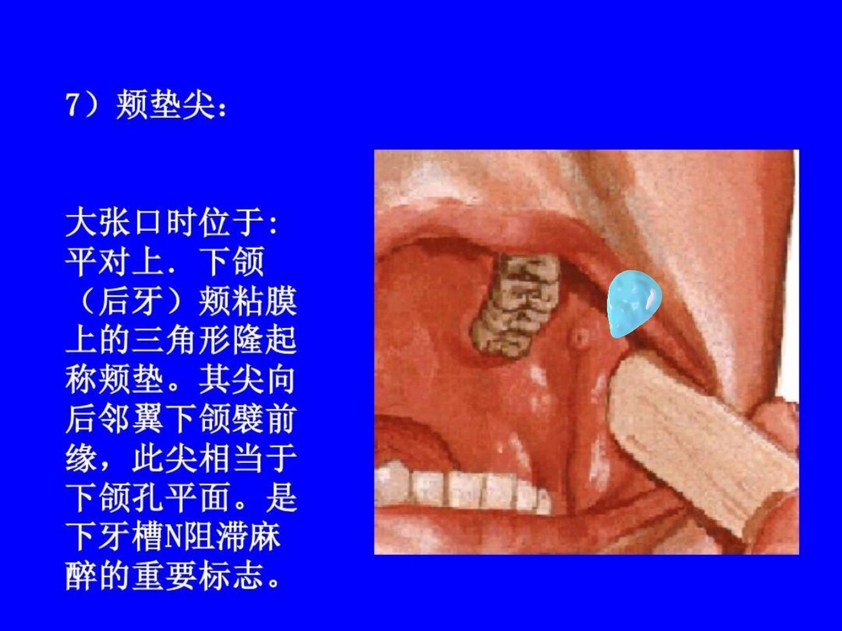 翼下颌皱襞发炎 我,最近又得了稀奇古怪的毛病,蓝点点那里,叫做翼下颌