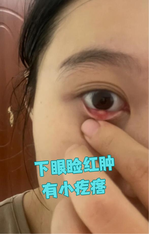 下眼睑红肿有小疙瘩,常见原因有三种:睑板腺炎,睑板腺炎囊肿和皮窒儋