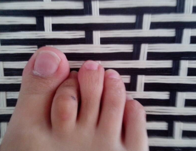 第二个脚趾弯曲伸不直可能和先天性发育畸形,外伤,拇外翻这些原倚有