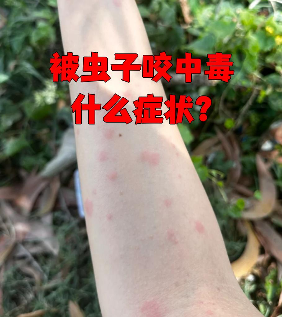 如果被蜜蜂,黄蜂,蝎子或蜈蚣等毒虫咬了,它们的毒液会刺激皮肤,德致