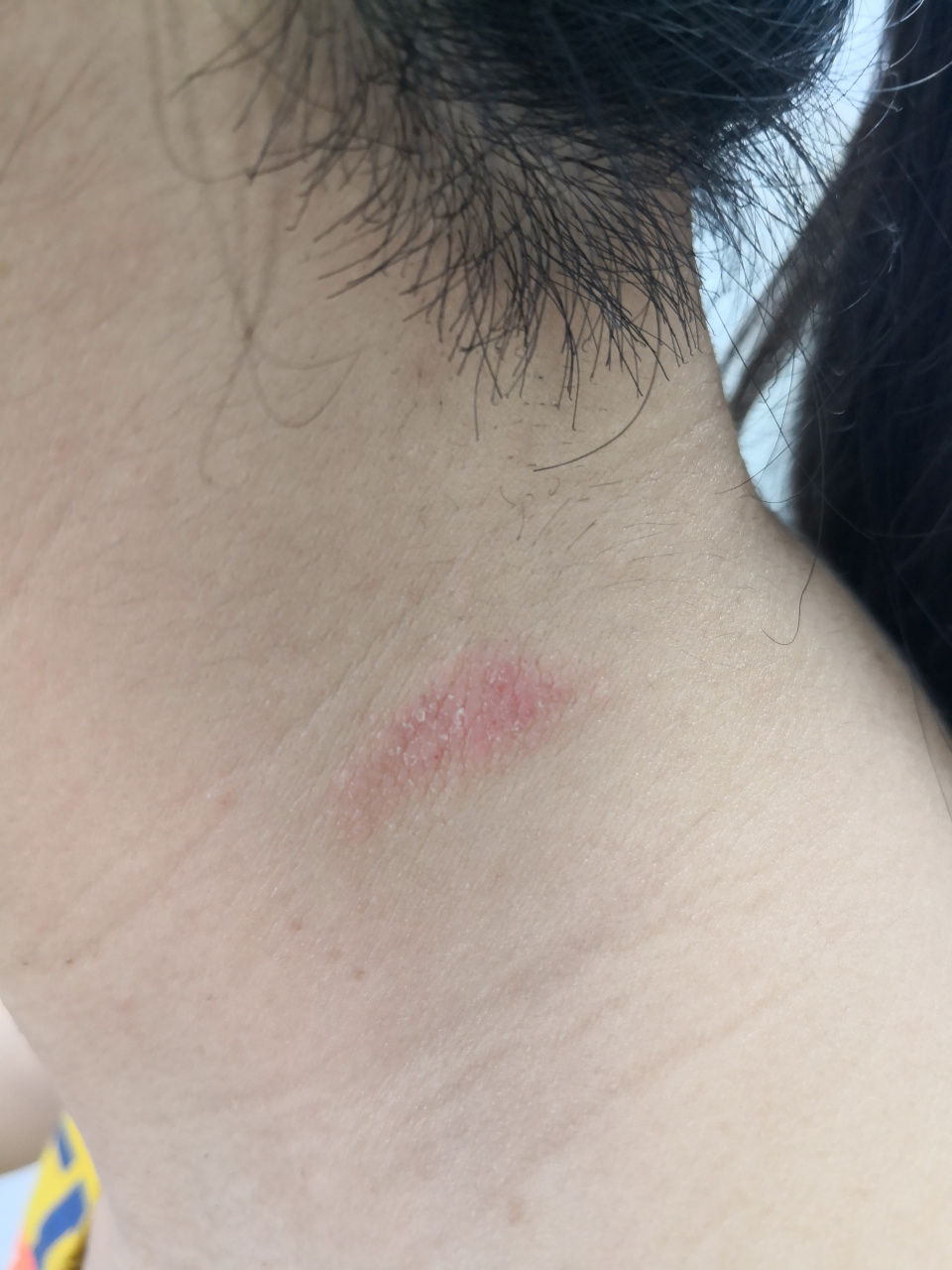 考虑神经性皮炎的症状#解决皮肤问题专注皮肤美容##神经性皮炎