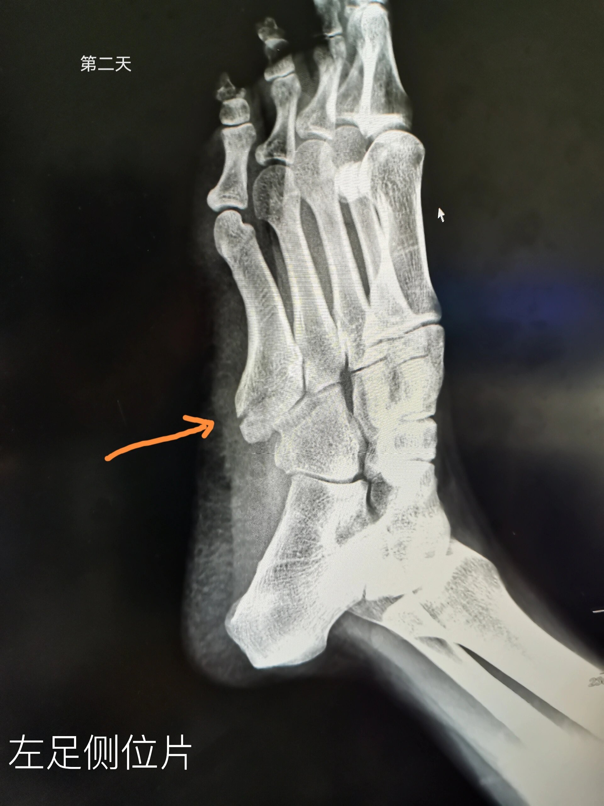 左足第五跖骨基底部撕脱性骨折 8月22号下楼梯扭脚