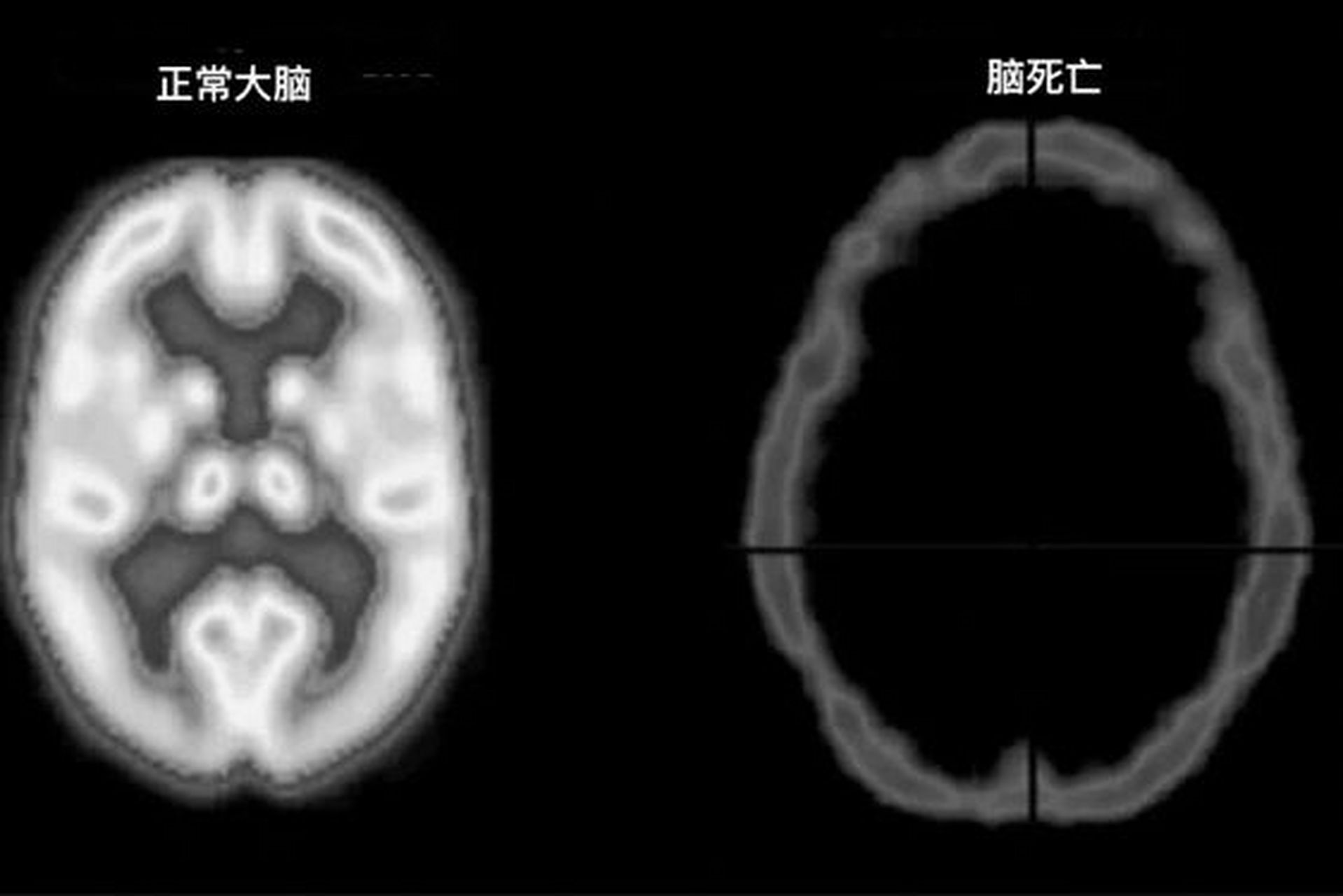 正常大脑与脑死亡 脑死亡是指永久性丧失脑部活动. 因此,患者无法自主