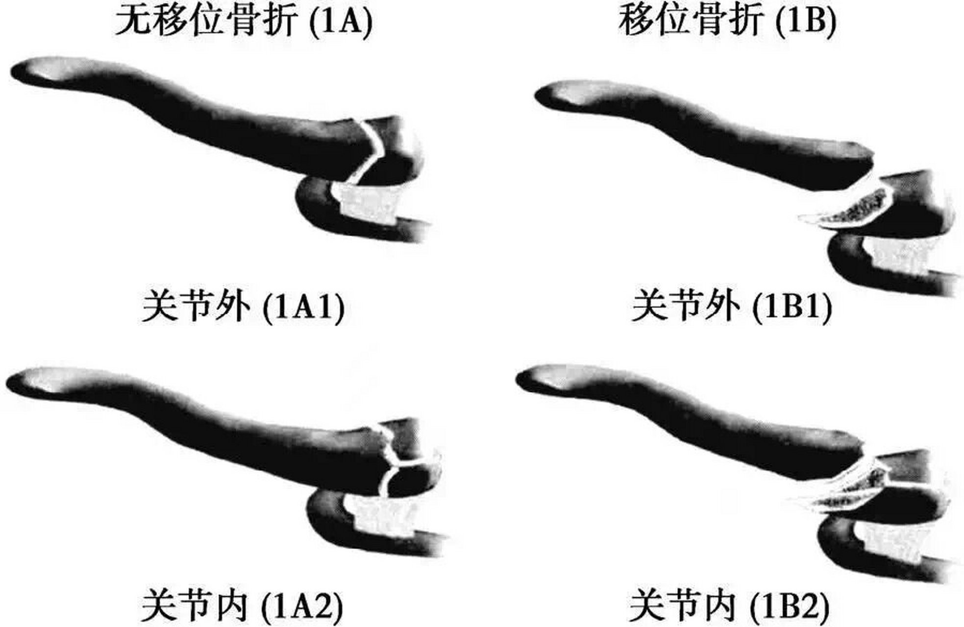 8字固定法锁骨 图解图片