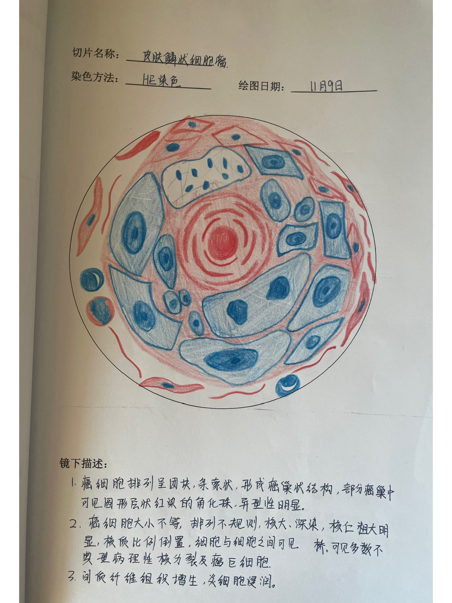 直肠腺癌病理绘图图片