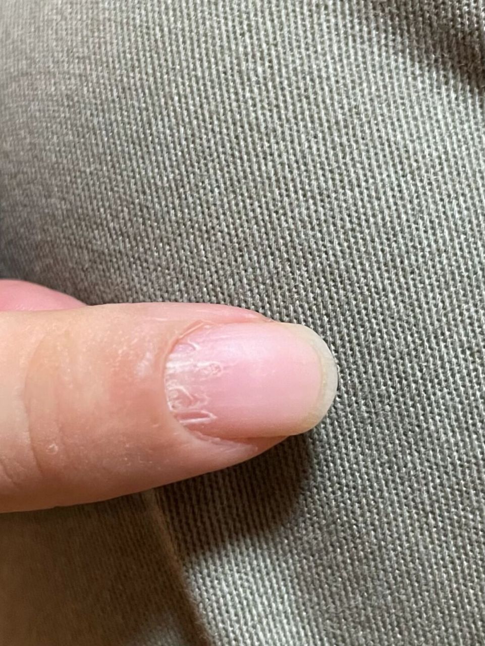 指甲里面长水泡怎么回事?