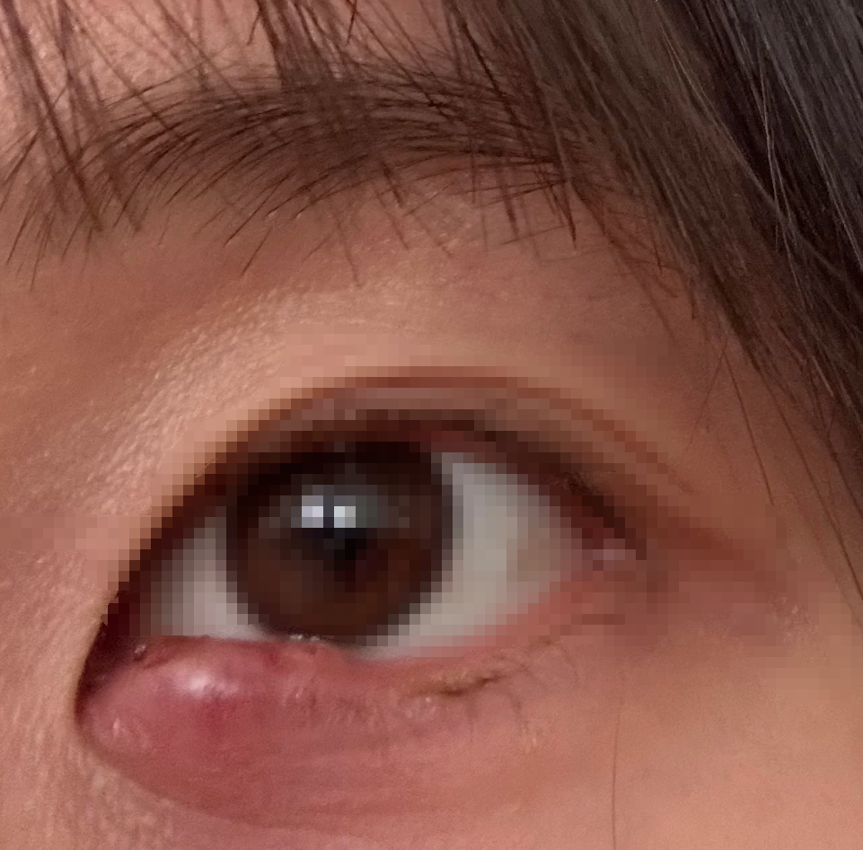 要这样处理:这是睫毛根部的眼睑腺体被细菌感染引起的急性炎症