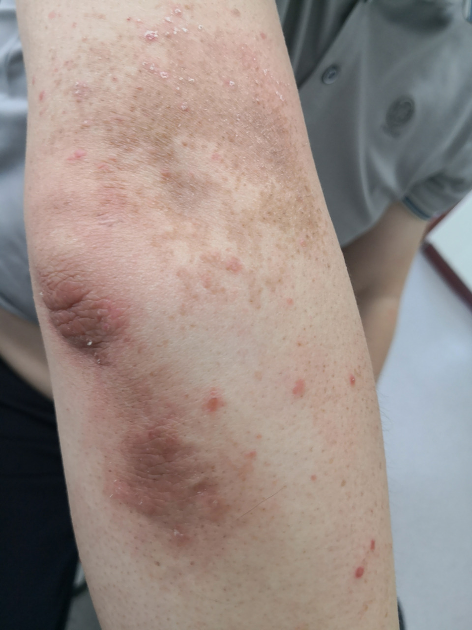 四肢散发鳞屑性斑点斑块症状.考虑点滴型银屑病症状#银屑病##牛皮癣