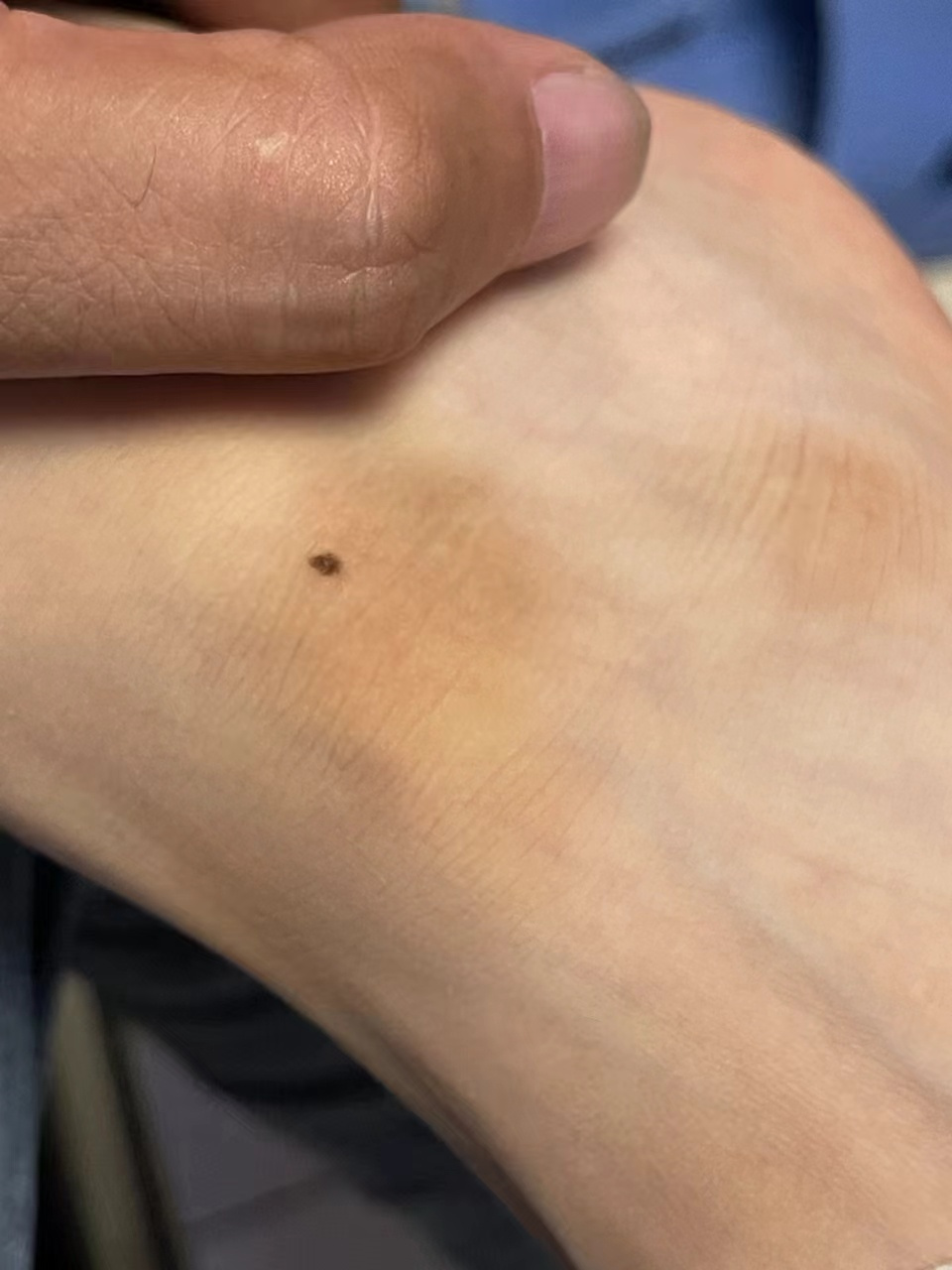 这种足部摩擦部位的色素痣,手术切除活检诊断一下比较好.