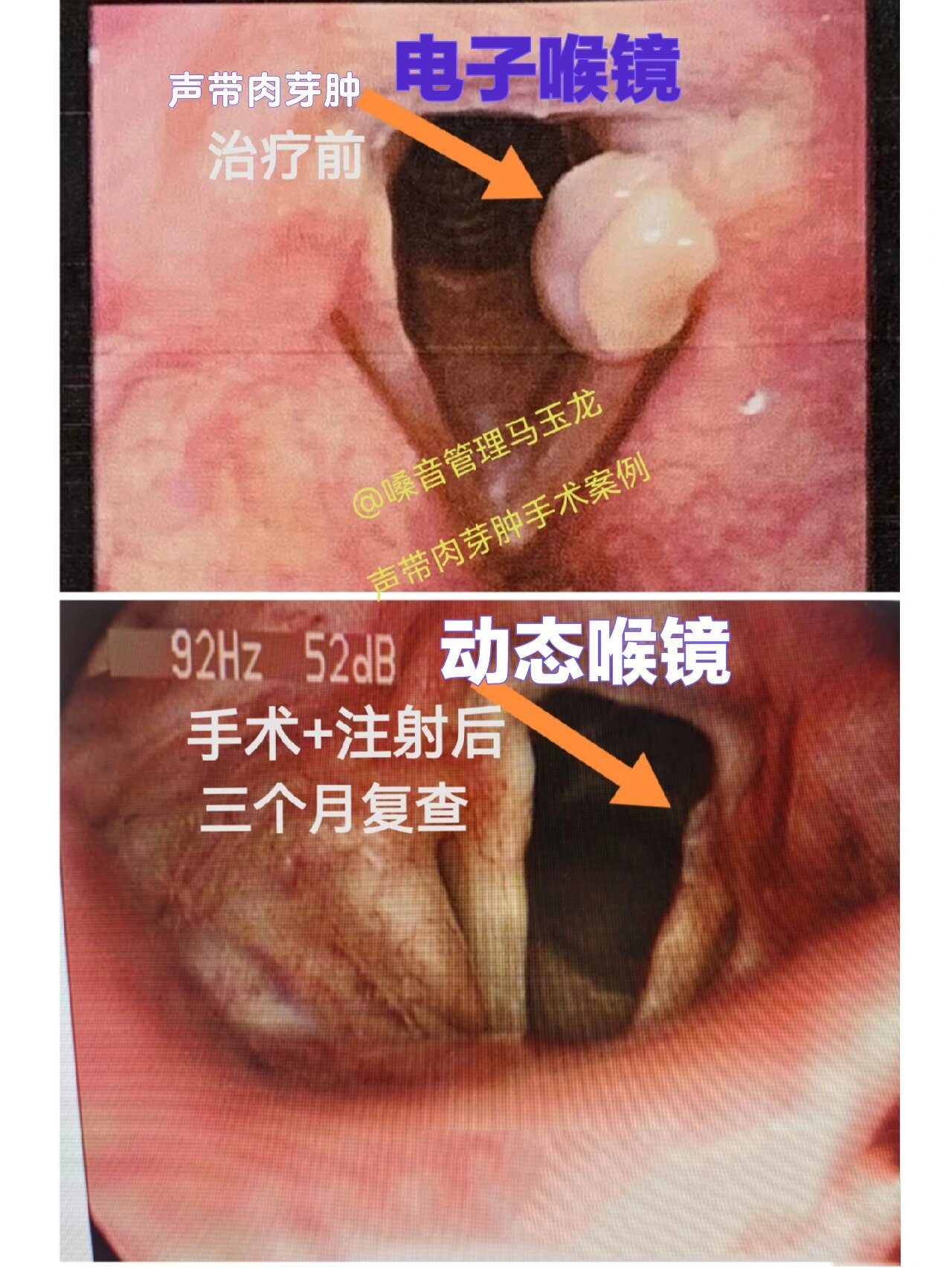声带肉芽肿手术 注射三月后复查 声带肉芽肿(喉接触性肉芽肿)是一种