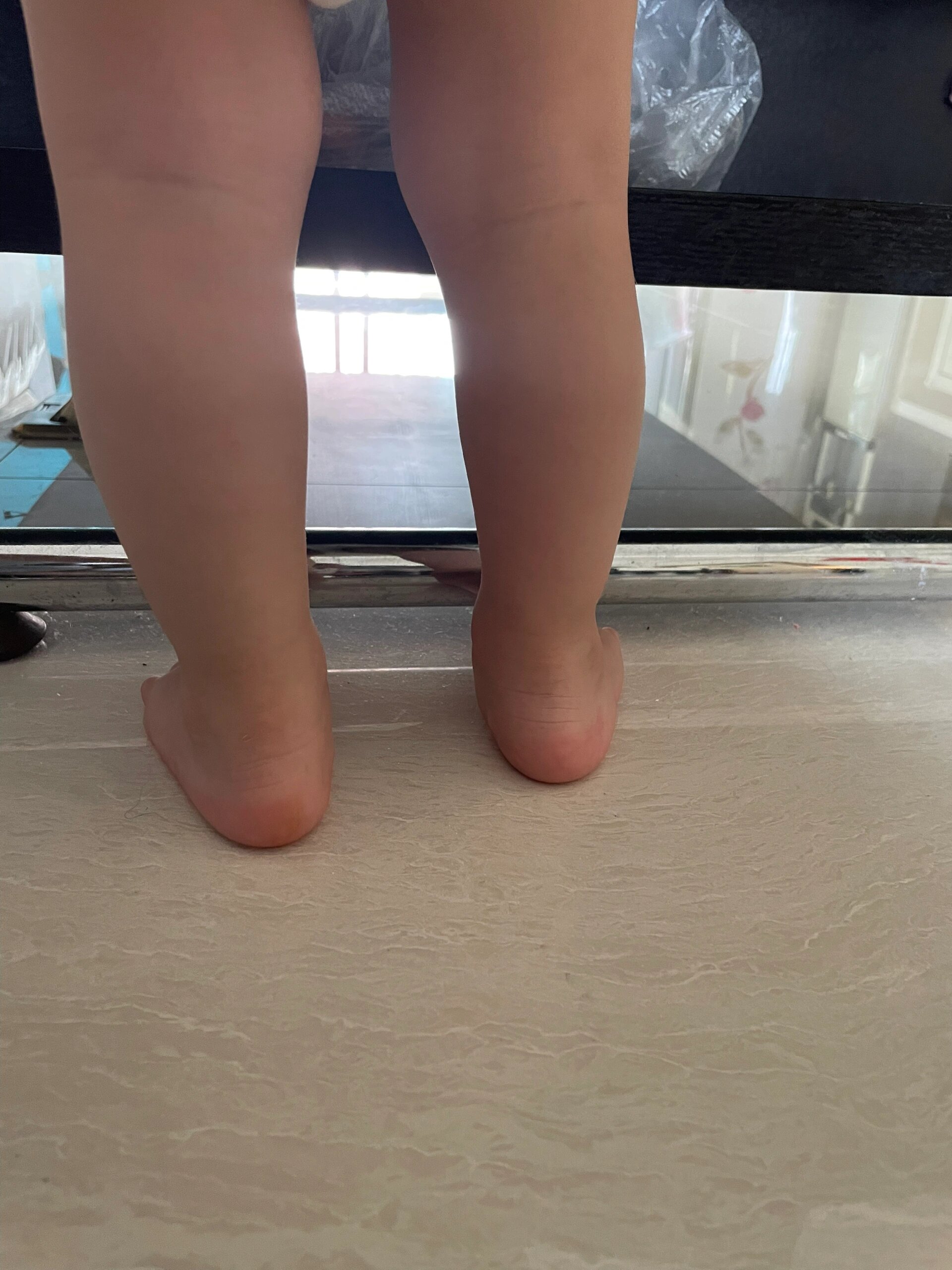 焦虑!一岁半宝宝足外翻怎么办?