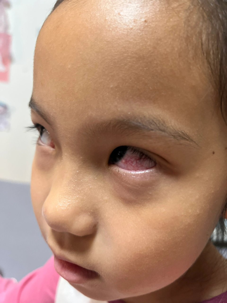 小孩子眼睛红血丝～结膜炎 小孩子眼睛红血丝3到5天基本可以自愈 但