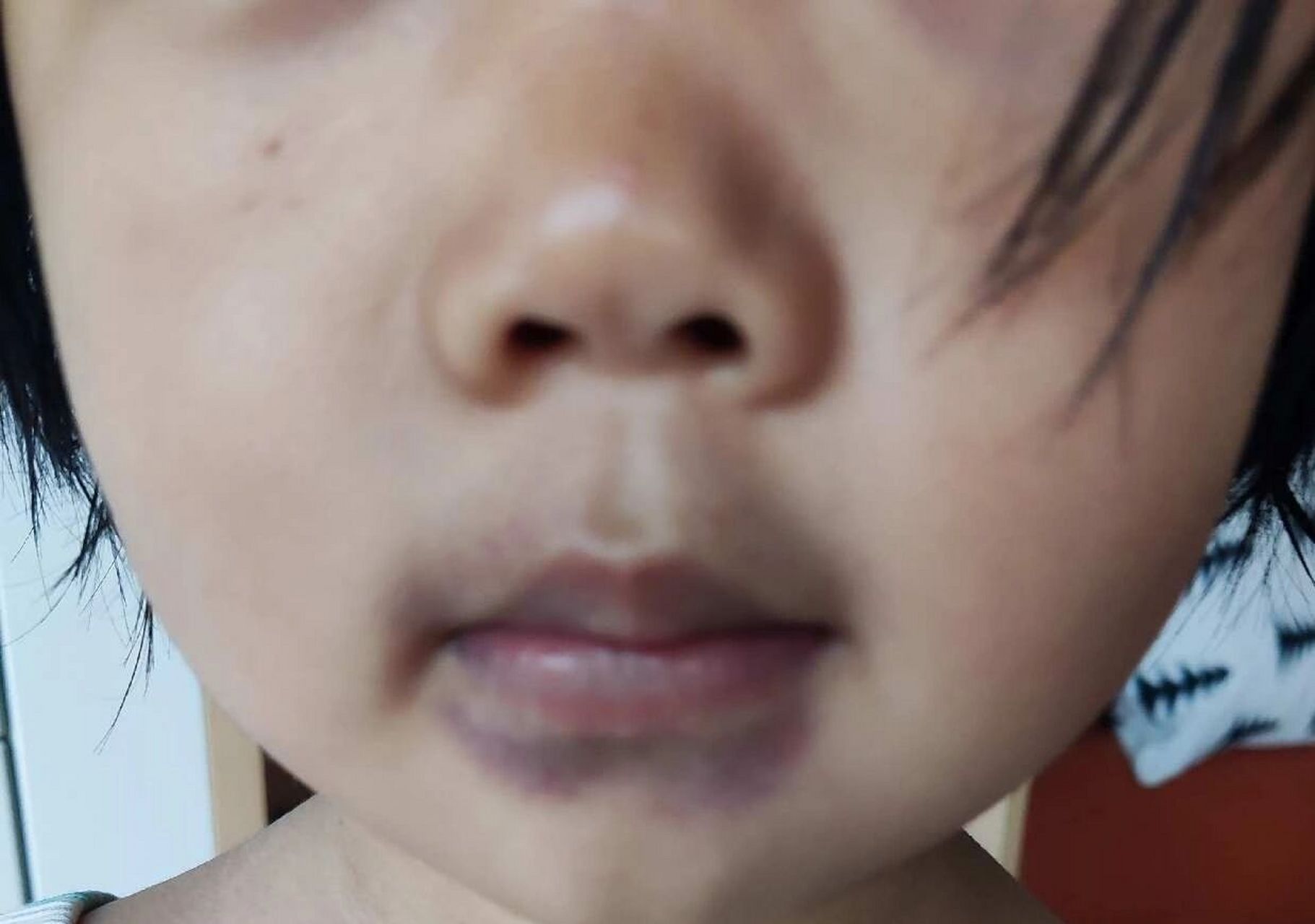 小孩子嘴周发黑咋回事 昨天晚上说痒,今天没啥事就是了.