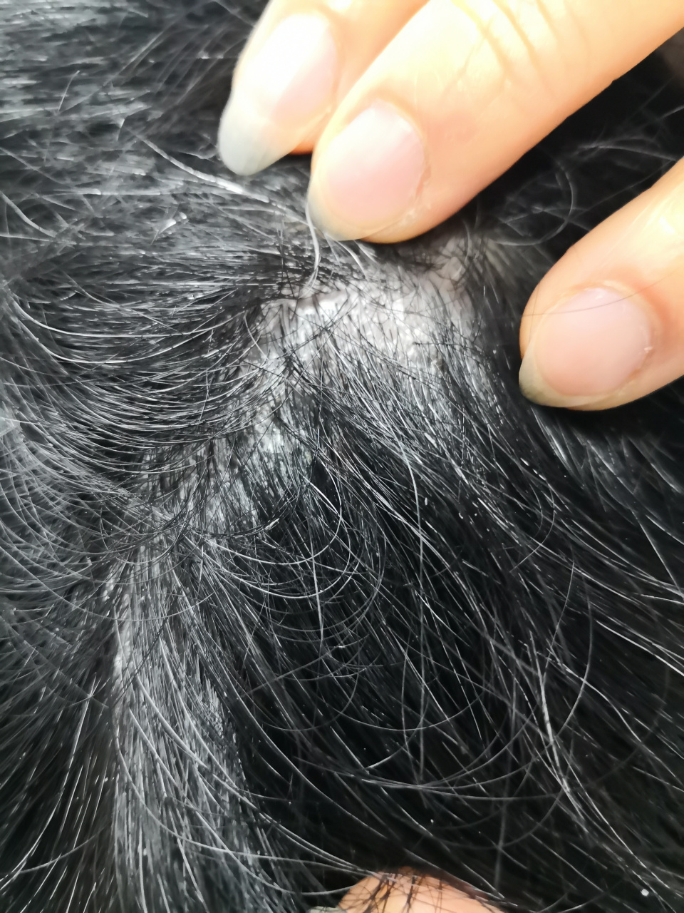 脂溢性皮炎# 可以使用药物治疗能够很快达到好的治疗效果.