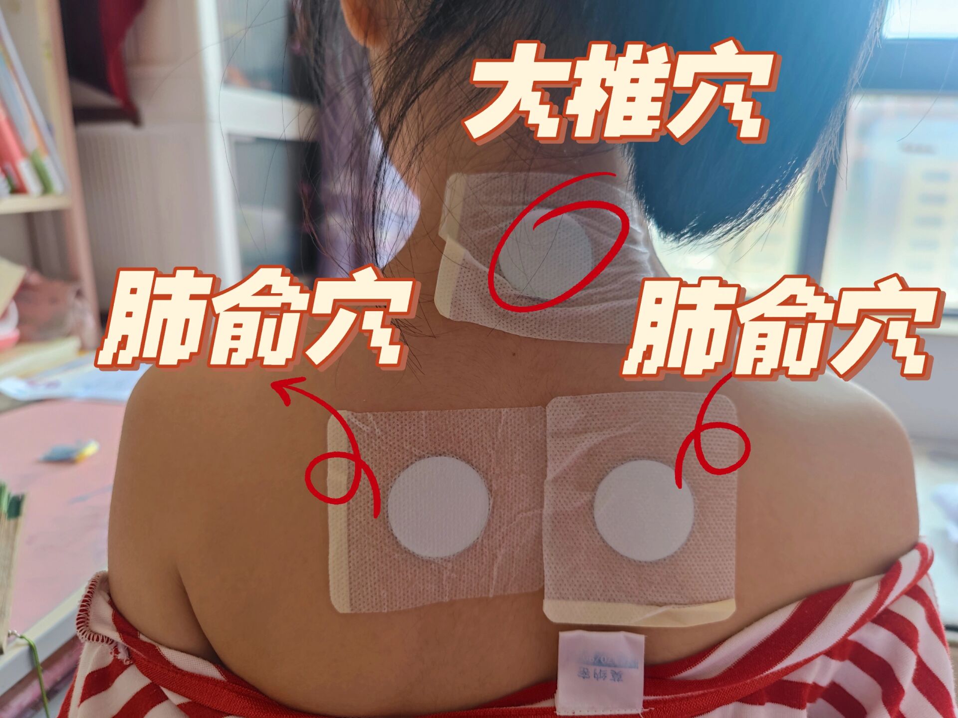 儿童三伏天炎调理~ 今天初伏第一天,小朋友的三伏贴炎调理~ 鼻炎:正面