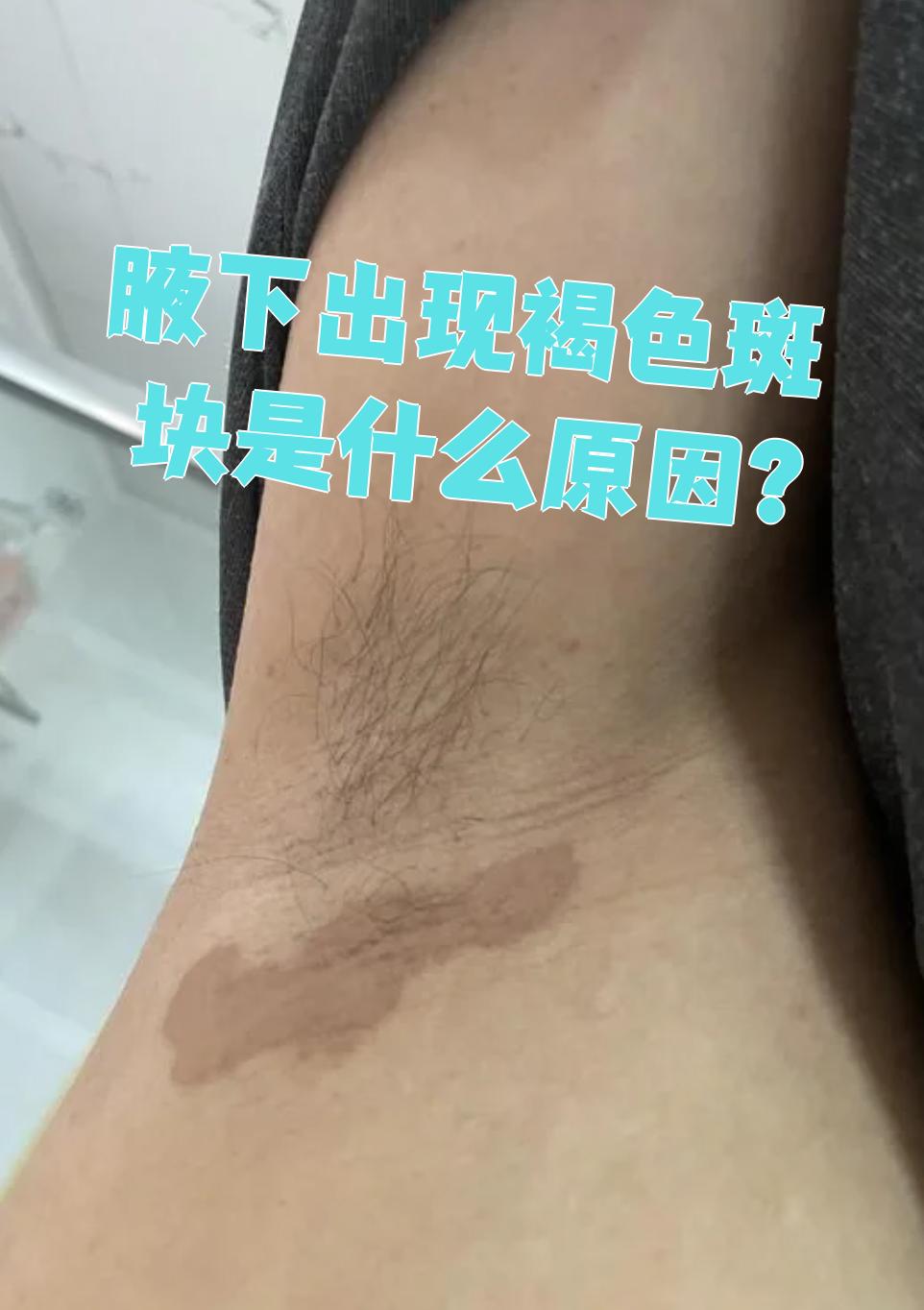 腋下褐色斑块可能由玫瑰糠疹,体癣或花斑癣引起
