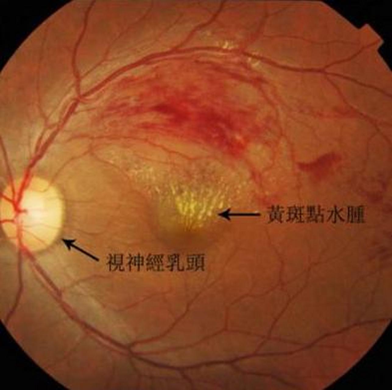 黄斑水肿,你打针了吗?打的什么针? 1.雷珠单抗 2.康柏西普 3.
