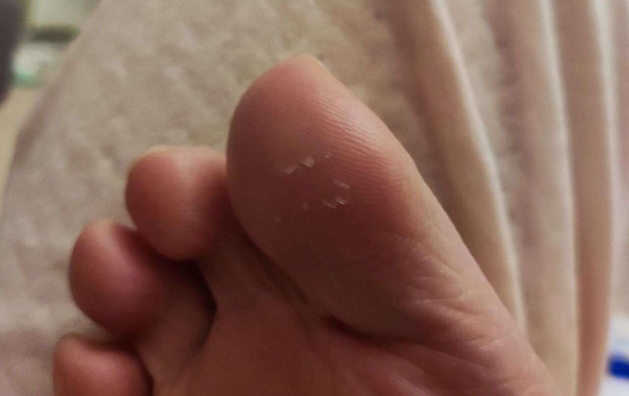 脚趾倒刺是为什么?