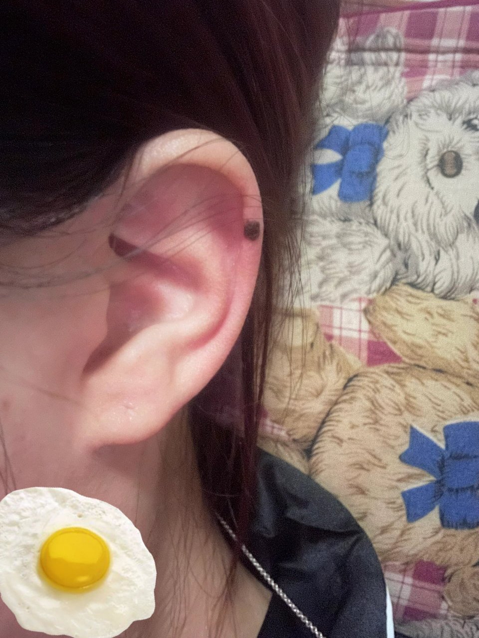 右耳突然长了颗痣 有人右耳也突然长痣嘛?