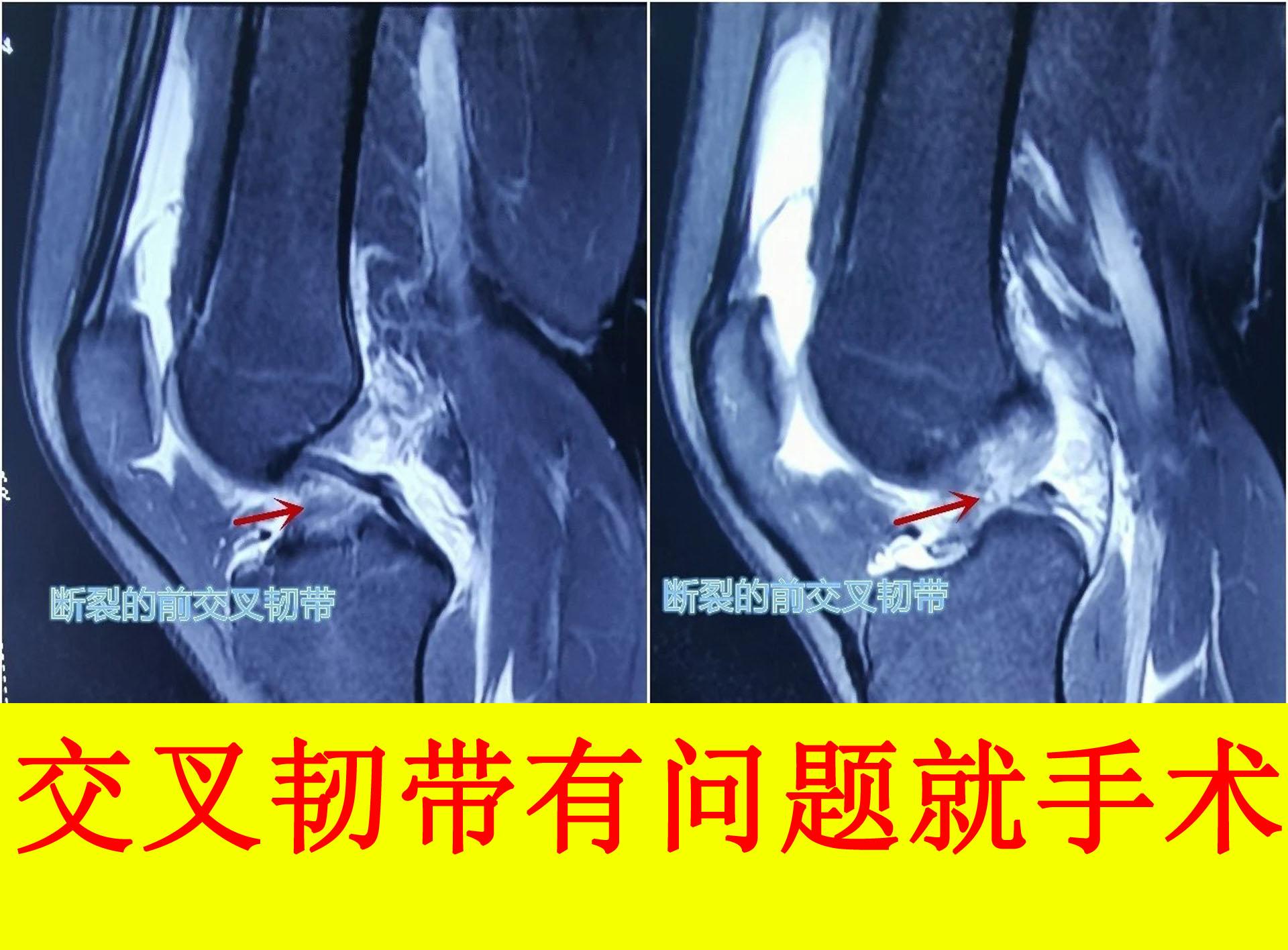 膝关节前交叉韧带撕裂百分之30现在保守治疗三个月能弯曲120度但是