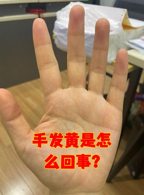 手发黄可能是由多种原因引起的,最常见的有饮食