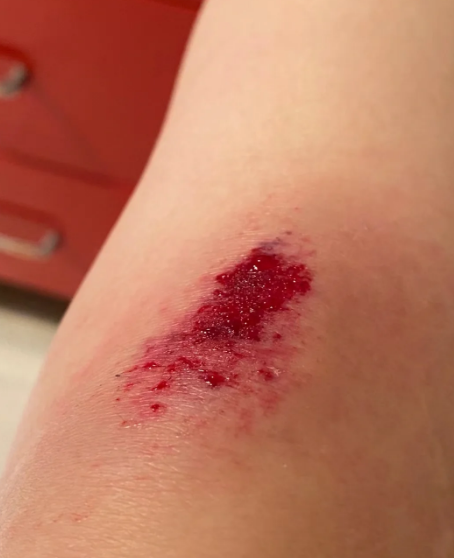 老年人膝盖出现血珠,可能是外伤,维生素k缺乏或血小板功能异常引起