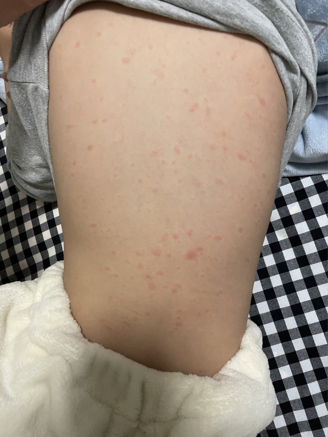 幼儿急疹引发的血小板低 家长一定不要恐慌