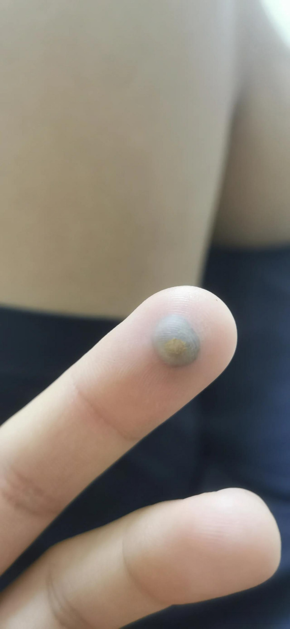 手上有跖疣,冷冻疗法究竟有没有用?