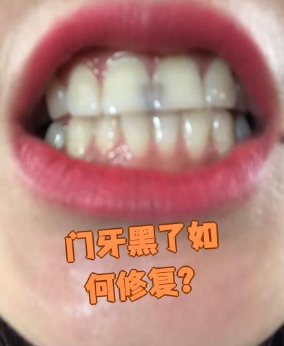 牙为什么会变黑