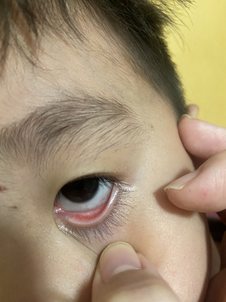 去年六月份眨眼睛一个多月,去了广州妇儿中心说是结膜炎,滴了眼药水