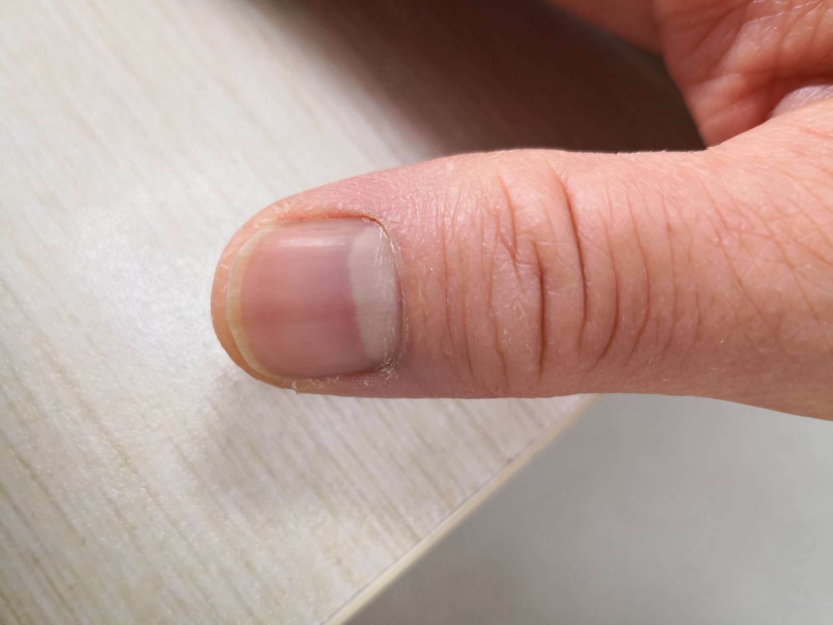 甲黑线#甲母痣# 可以观察#灰指甲