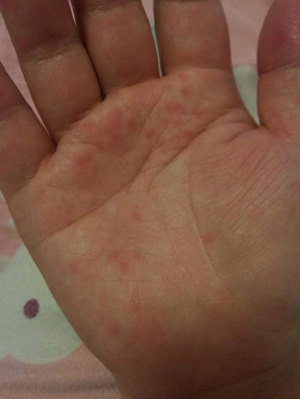 疱疹:手上出现小红点可能是疱疹病毒引起的皮肤感染.