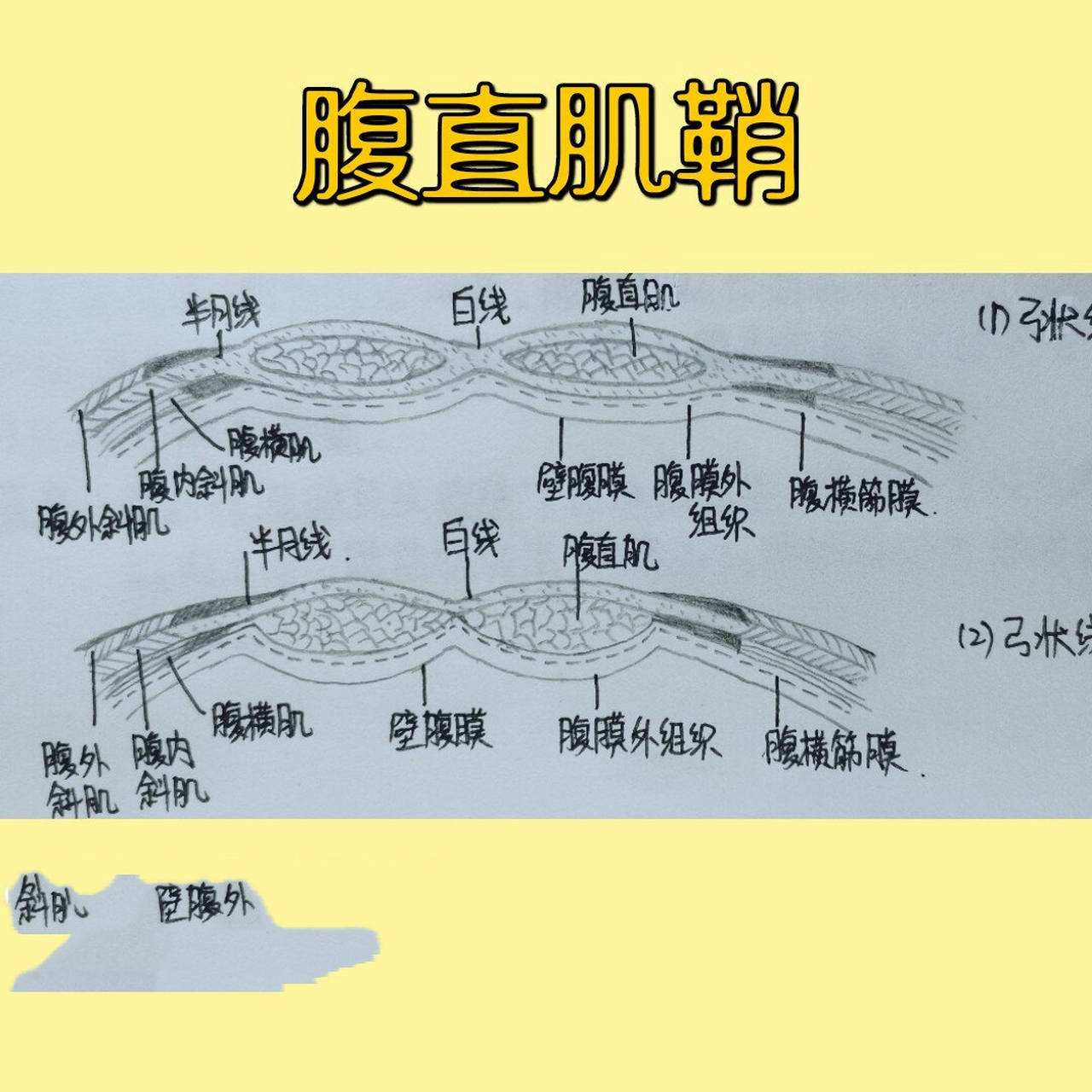 局解手绘6‖腹直肌鞘 上:弓状线以上断面 下:弓状线以下断面