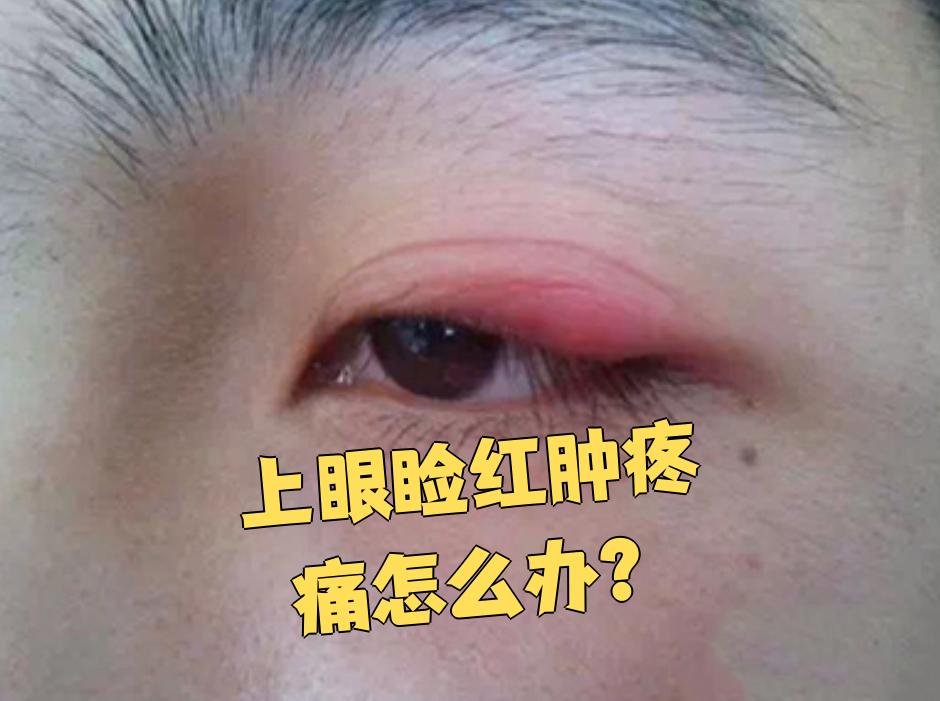 上眼睑红肿,疼痛常见原因包括睑腺炎,睑板腺囊肿和带状疱疹病毒性睑