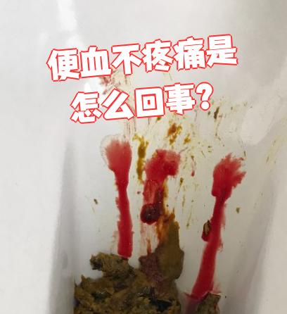先说内痔.这是长在肛门里面的静脉团,主要表现就是拉完大便后出血