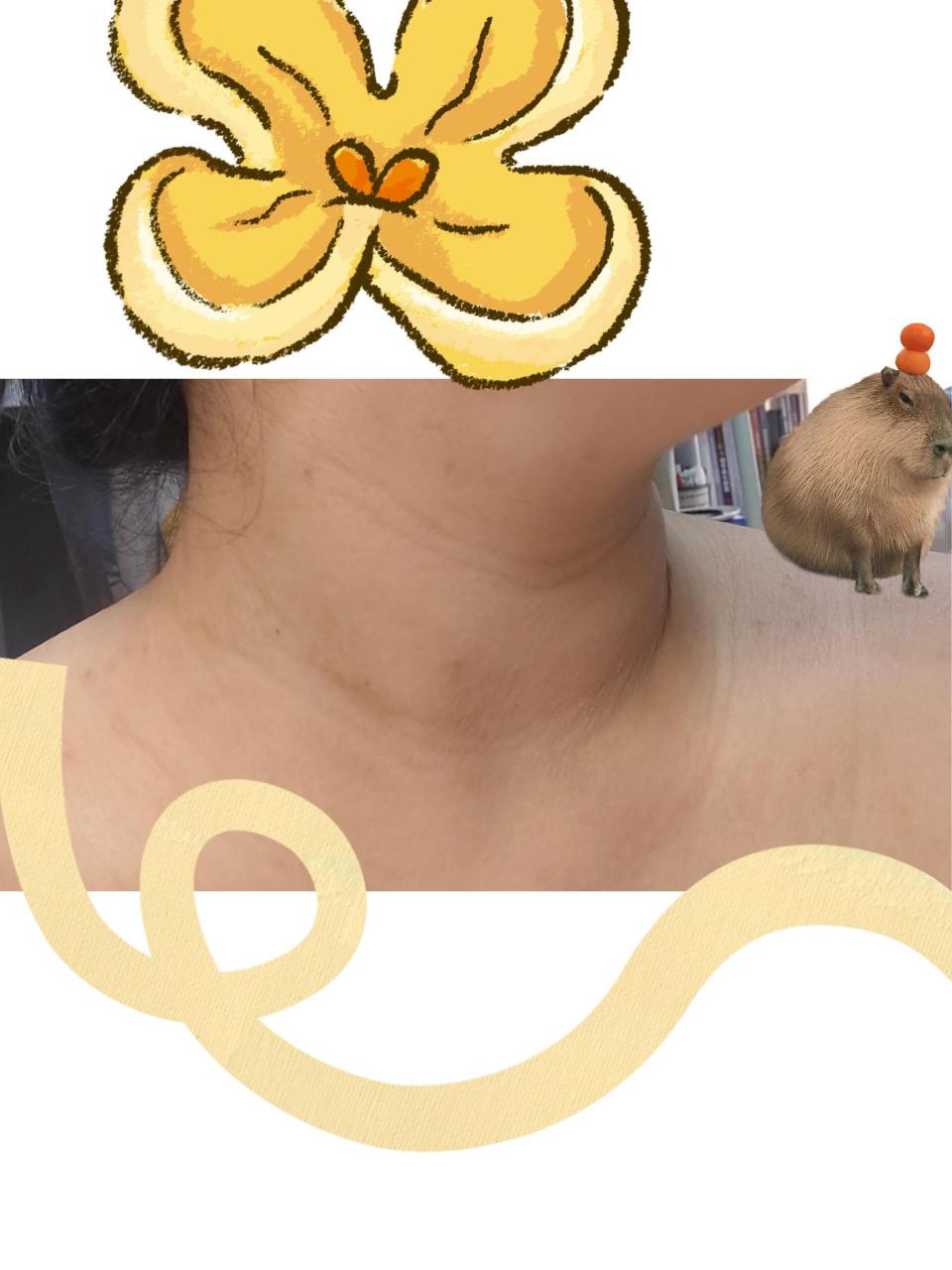 我脖子上的黑棘皮是这样的 就是脖子上那些黑黑的地方 去年夏天就有了