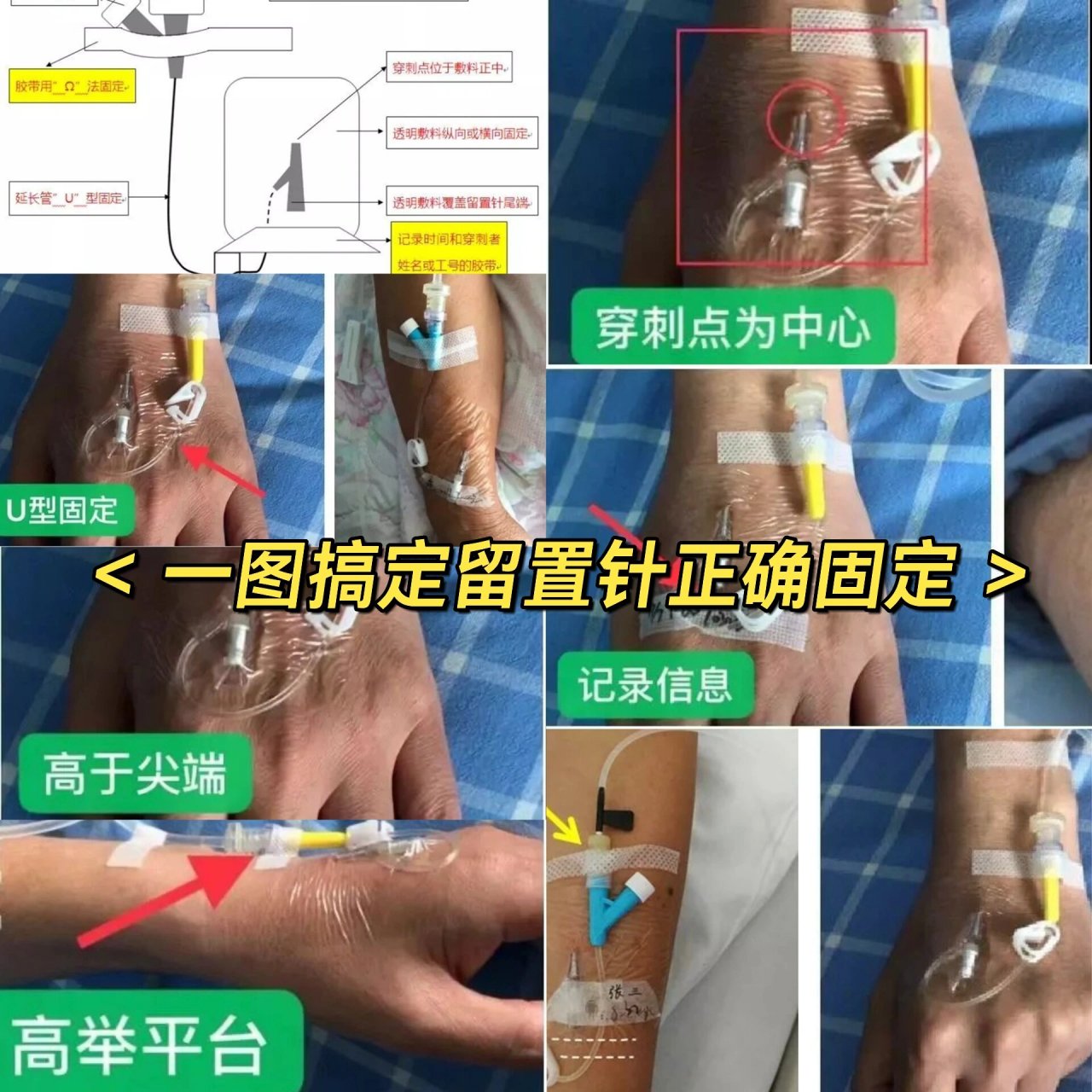 留置肛管固定方法图片图片