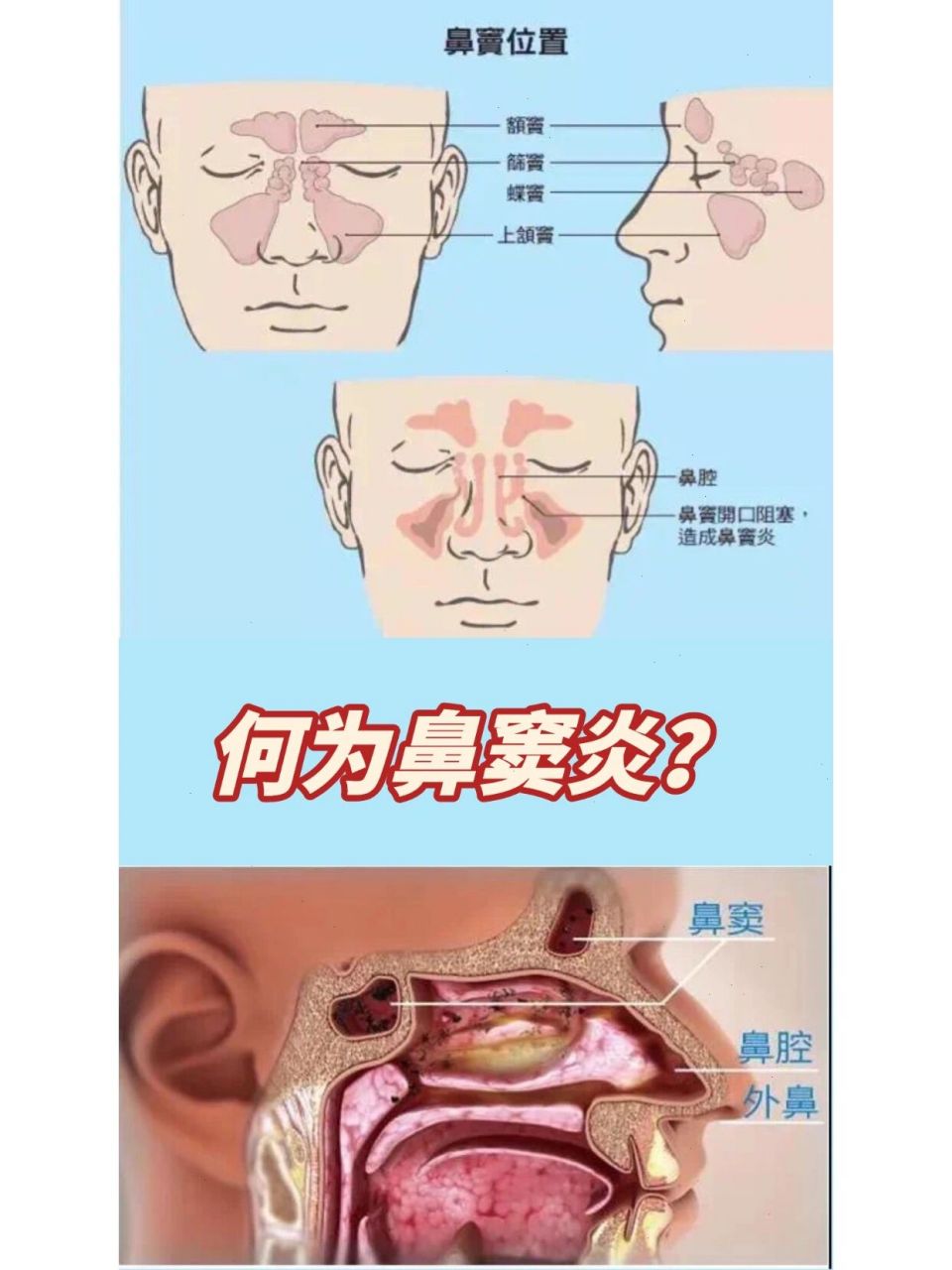 94鼻炎是鼻腔粘膜的一组炎性病变,而鼻窦炎是鼻窦粘膜的炎性病变