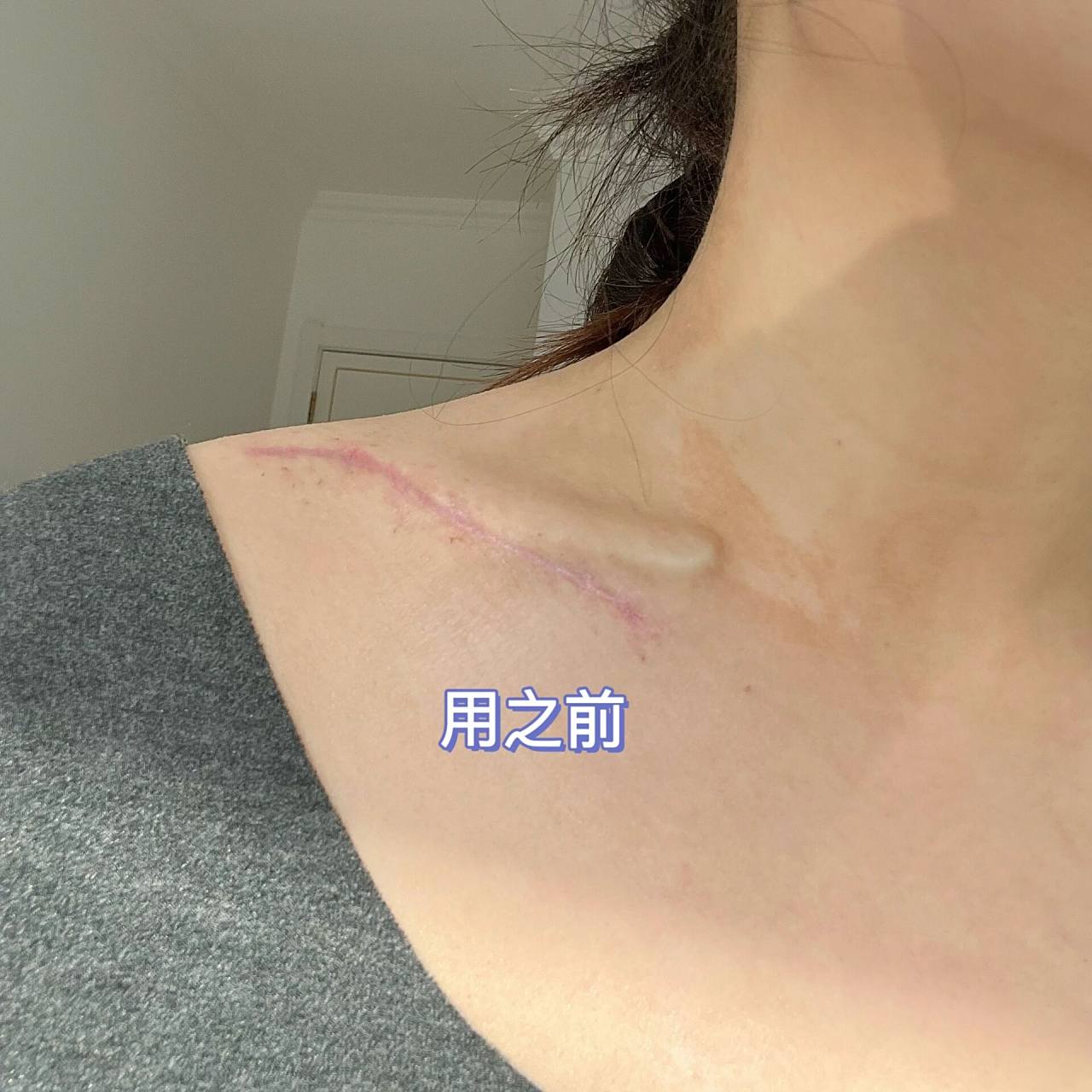 锁骨骨折术后71天|刀口伤疤可以涂碘伏护理  伤筋动骨100天 今天是