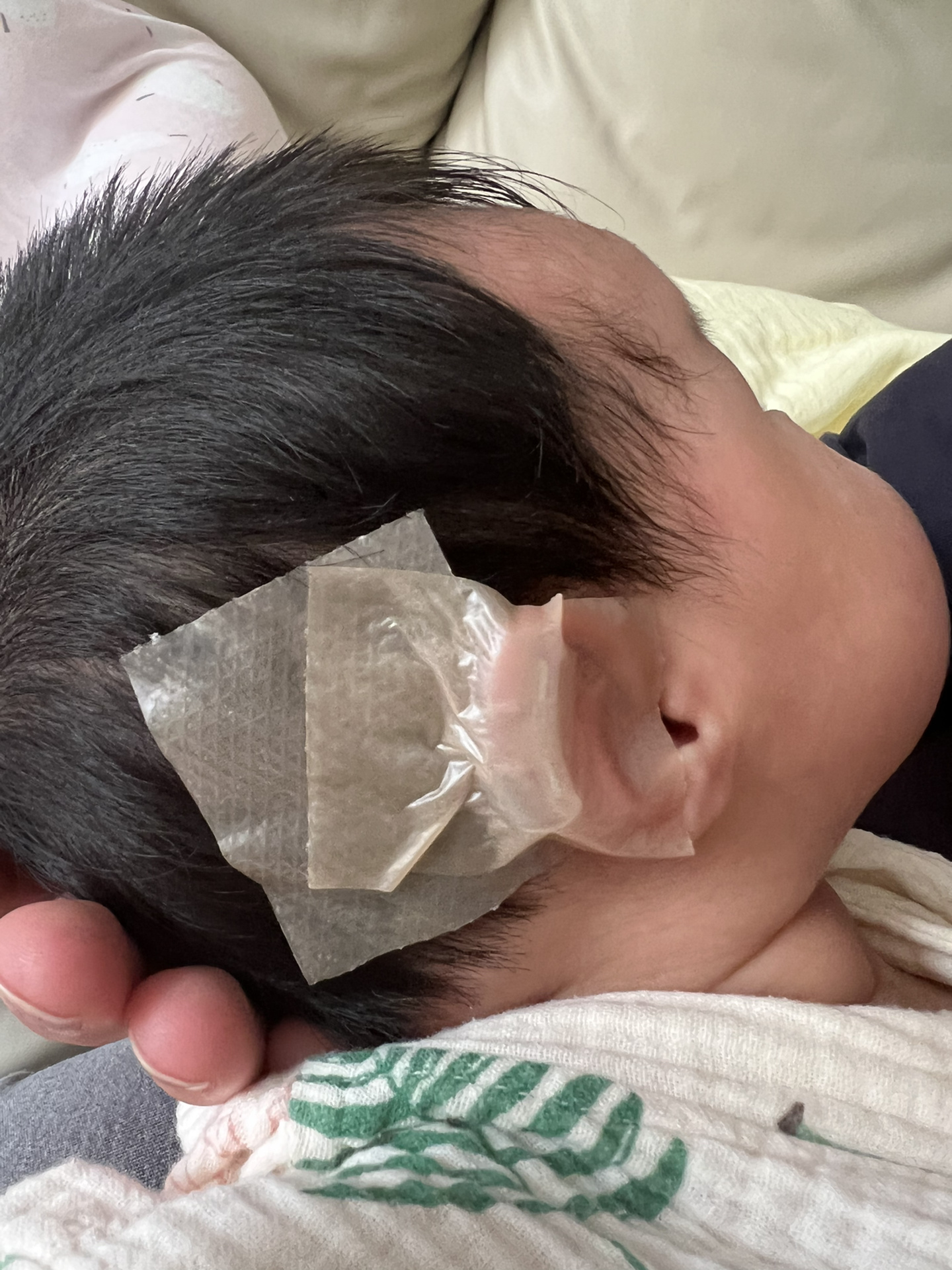 婴儿耳廓耳朵粘连,捋根本捋不开 我家孩子耳朵生出来就这样,婴儿耳廓