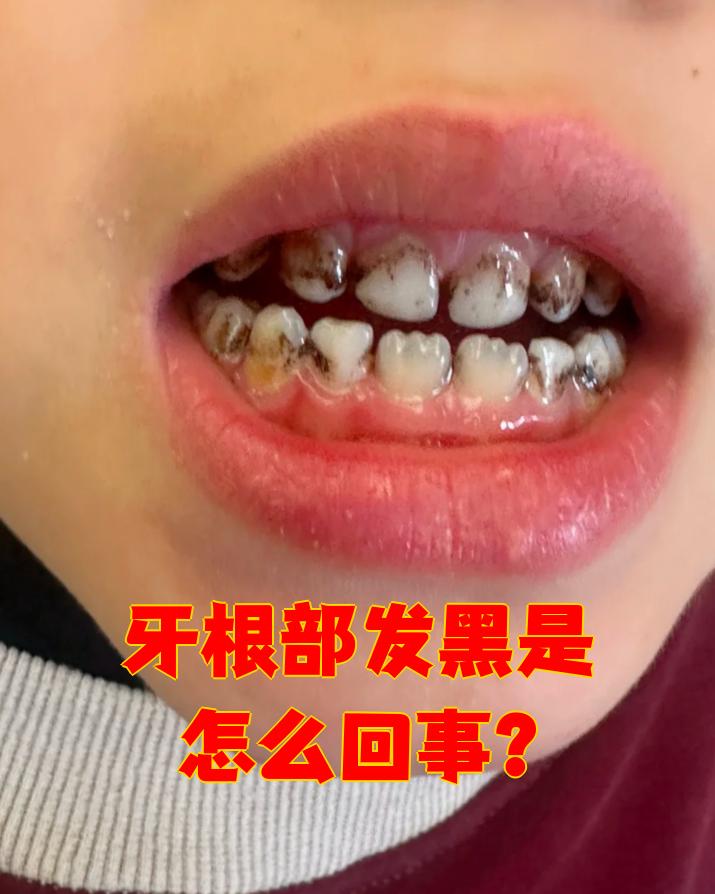 牙根部发黑最常见的原因是牙根暴露或出现龋洞