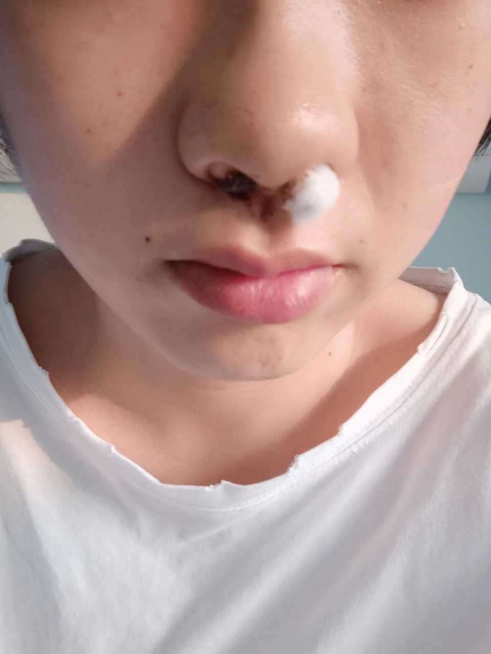 鼻中隔偏曲矫正手术 术后分享 97先说一下我的基本情况,我是右侧鼻