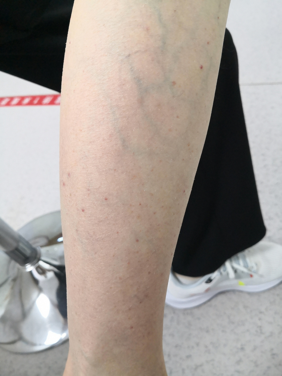 考虑过敏性紫癜症状#解决皮肤问题专注皮肤美容##紫癜