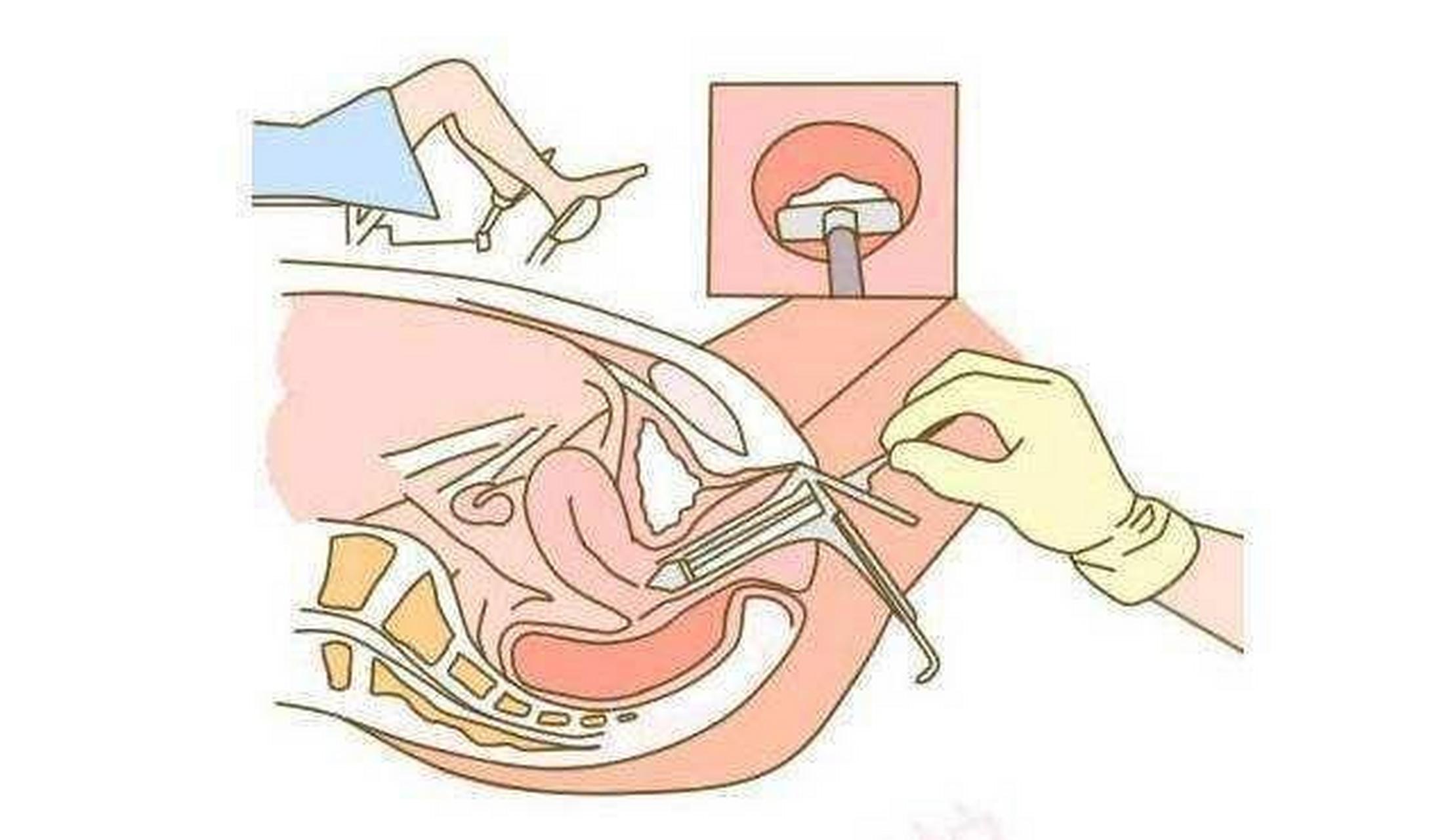 【阴道镜检查注意事项妇科】 1.