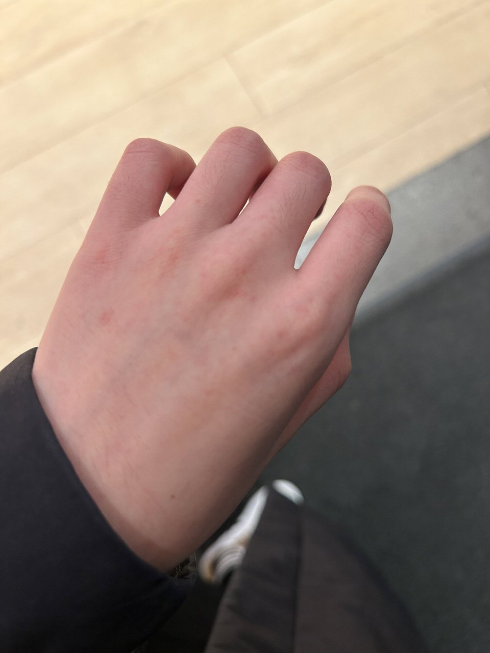 手背跟脚背上长了好多小红点点,有哪个集美能告诉我这是什么东东吗?