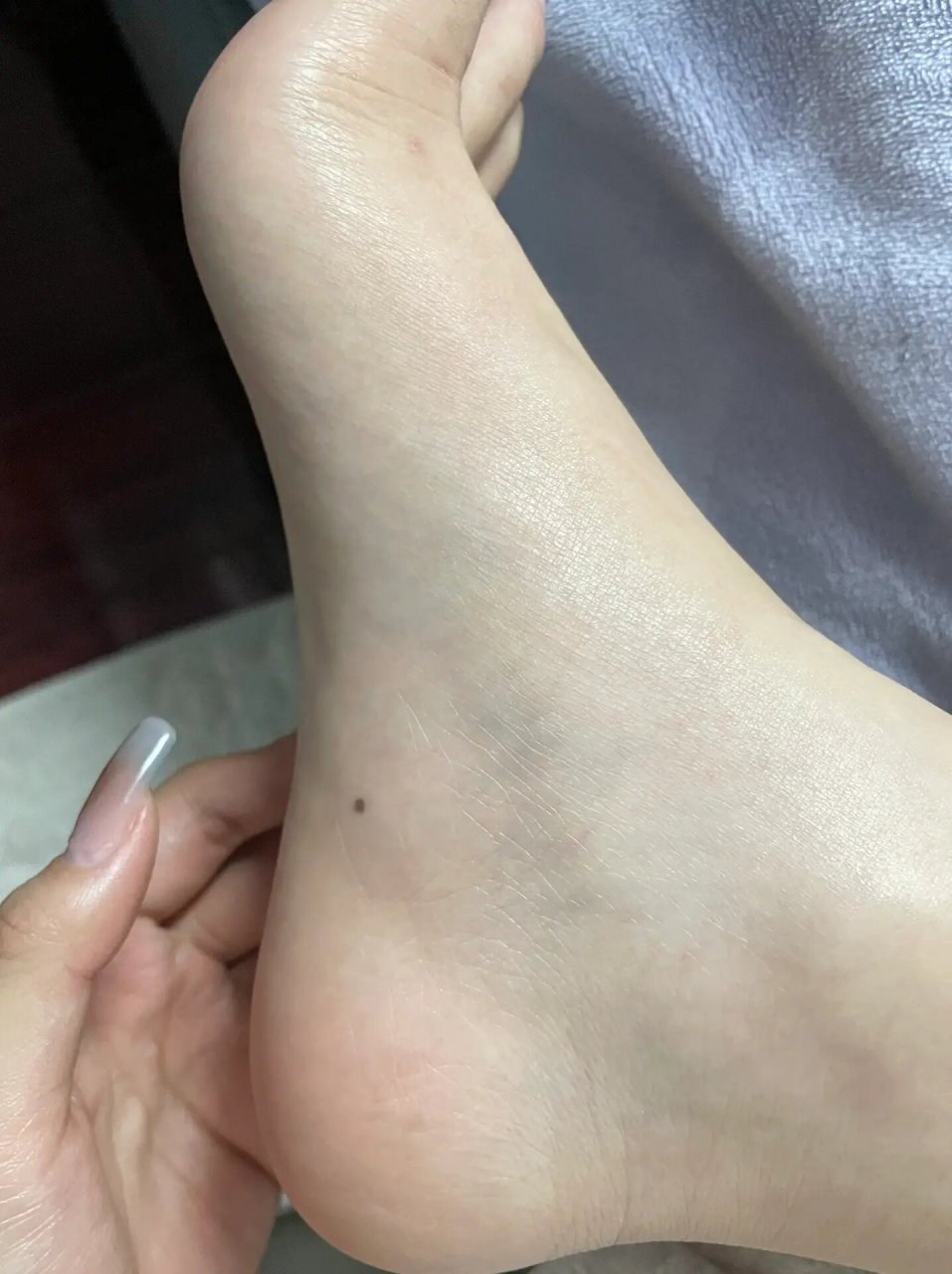 脚的侧面有痣 不是突然长出来的 一直有的 要不要紧啊 看到好多姐妹都
