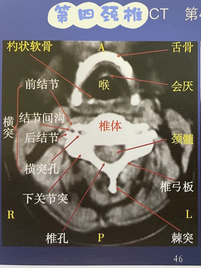 颈椎磁共振图片详解图片