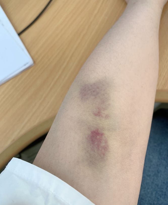 手臂摔伤后出现淤青肿痛,可以这样处理: