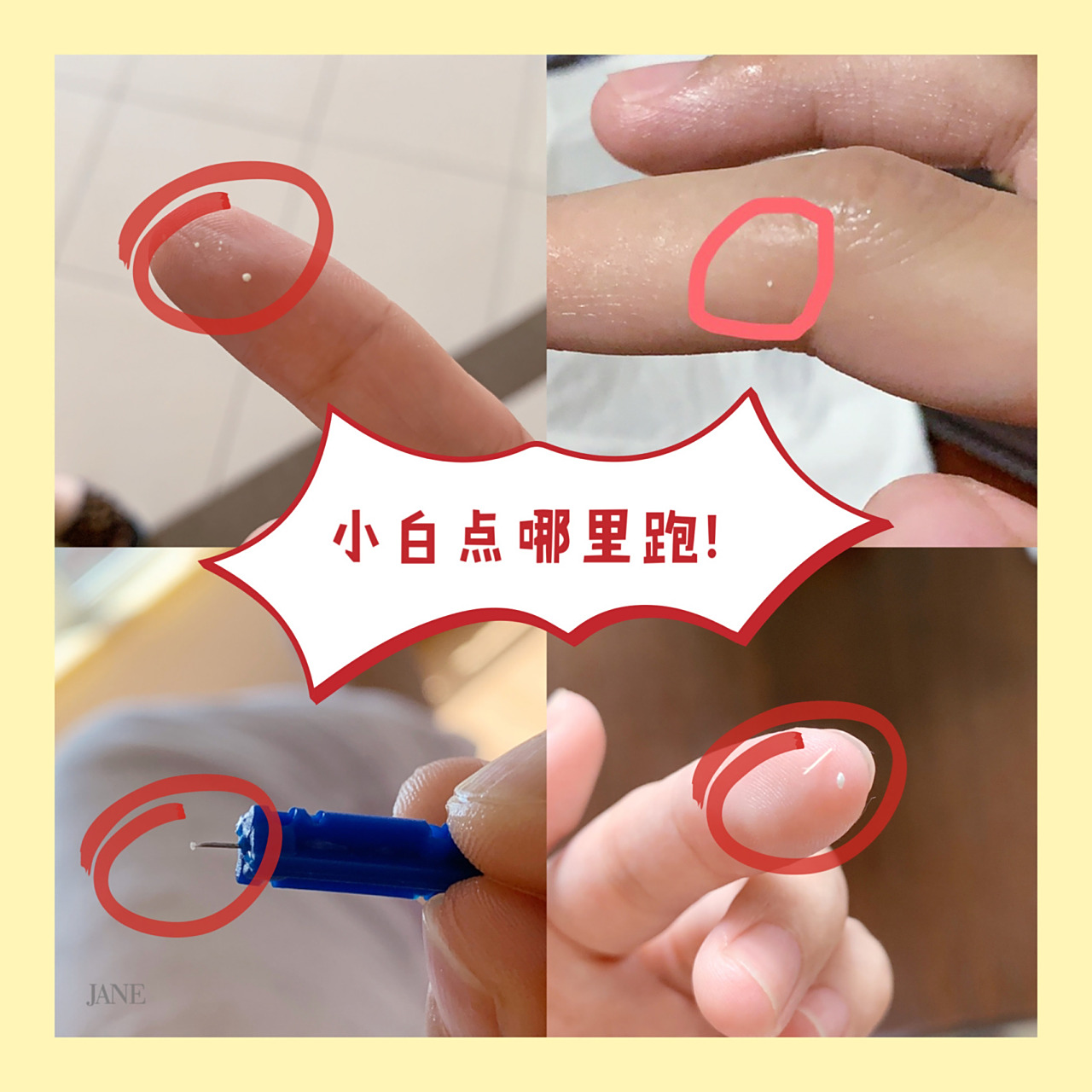 堵奶自救1|乳头小白点,小白泡,乳头溃疡 我是易堵体质,从月子里开始就